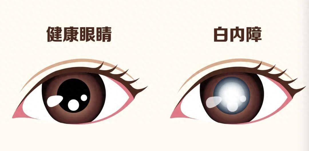 先天白内障网
